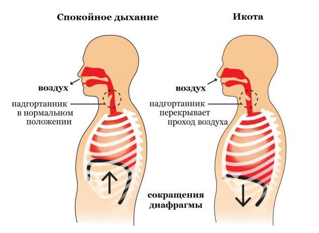 Hiccups: Causes and Treatments