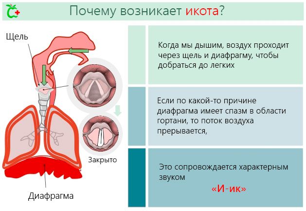 Hiccups: Causes and Treatments