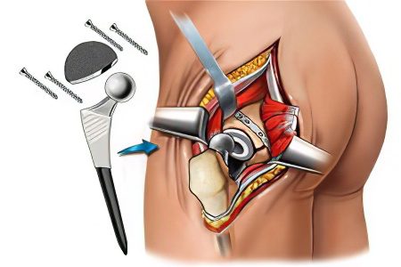 Hip arthroplasty: advantages and disadvantages, types