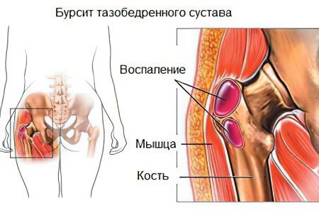 Hip bursitis