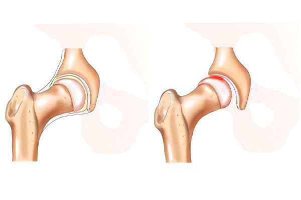 Hip dysplasia