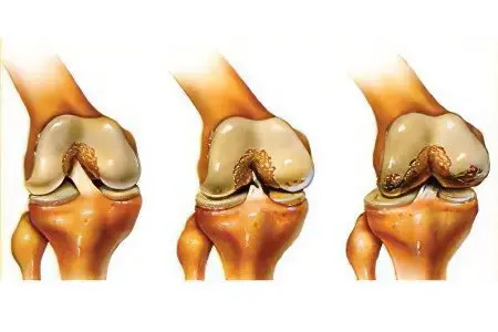 How is arthritis different from arthrosis?