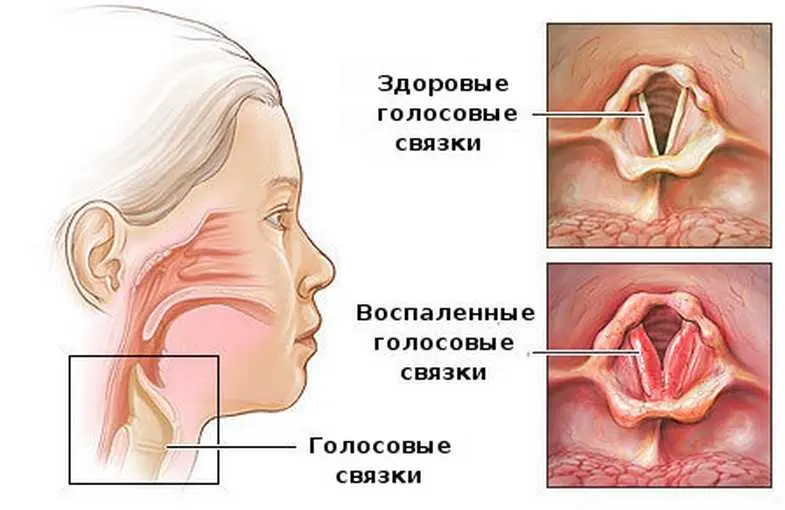 How is laryngotracheitis treated? What are its symptoms?