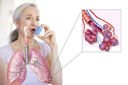 How is pneumonia different from other lung diseases?