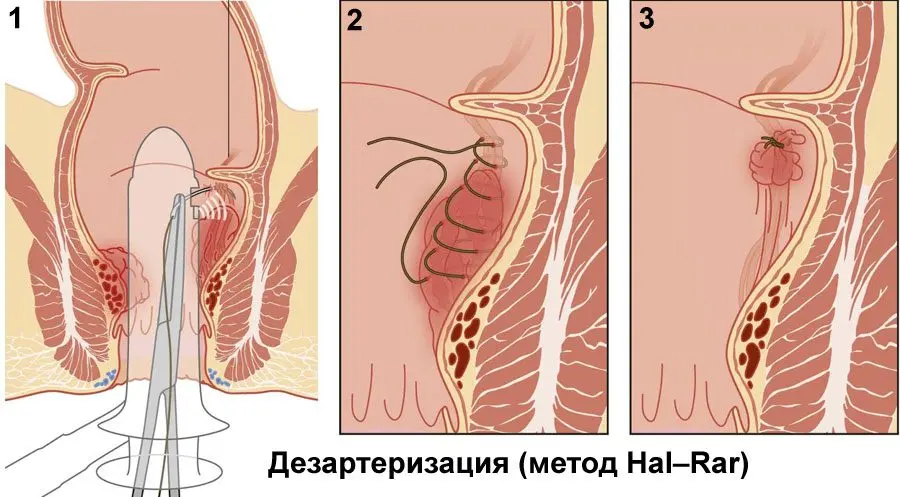 How to cure hemorrhoids at home: 9 ways