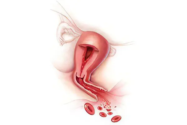 How to stop uterine bleeding? Causes, types and treatment