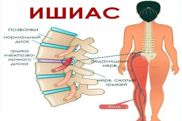 How to treat sciatica? Causes and symptoms