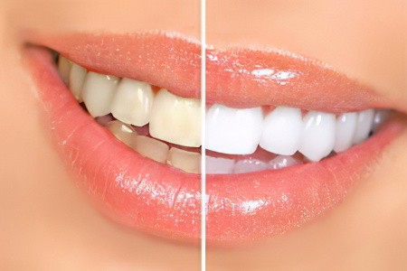 How to whiten teeth enamel at home?