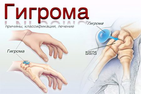 Hygroma: causes and treatment