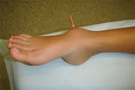 Hygroma of the foot