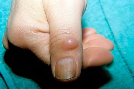 Hygroma on the finger