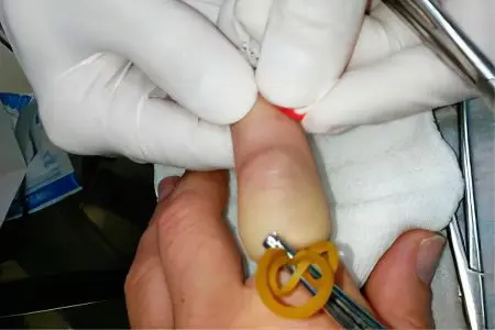 Hygroma on the finger