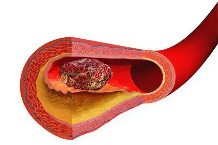 Hypercoagulability - what is it? Symptoms and treatment