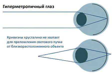 Hyperopia: symptoms and treatment