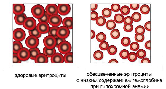 Hypochromia in a general blood test: what does it show?