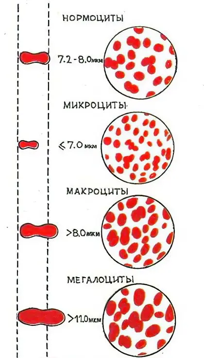 Hypochromia in a general blood test: what does it show?