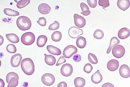 Hypochromia in a general blood test: what does it show?