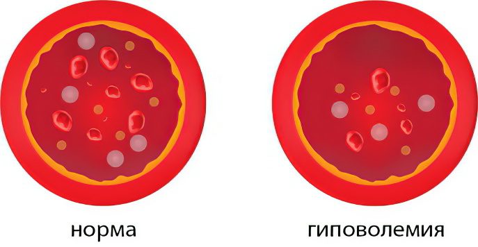 Hypovolemia: symptoms and treatment