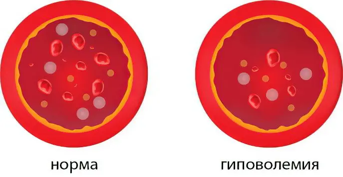 Hypovolemia: symptoms and treatment