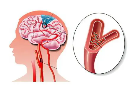 Hypoxia of the brain