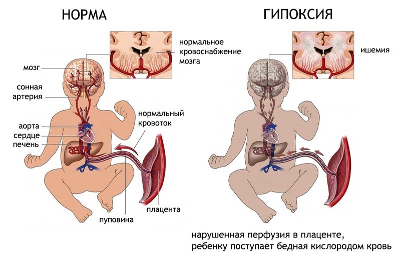 Hypoxic-ischemic lesion of the central nervous system in newborns