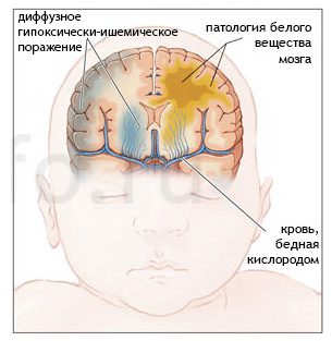 Hypoxic-ischemic lesion of the central nervous system in newborns