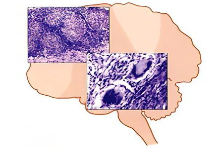 Hypoxic-ischemic lesion of the central nervous system in newborns