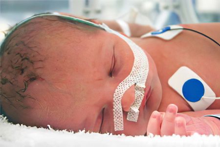 Hypoxic-ischemic lesion of the central nervous system in newborns