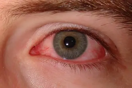 If the eye turns red &#8211; what to do?