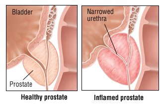 If the husband has prostatitis