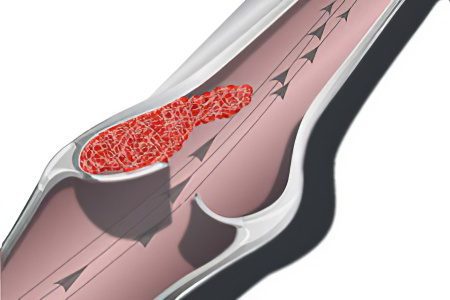 Ileofemoral thrombosis