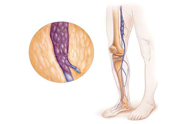 Iliac vein thrombosis