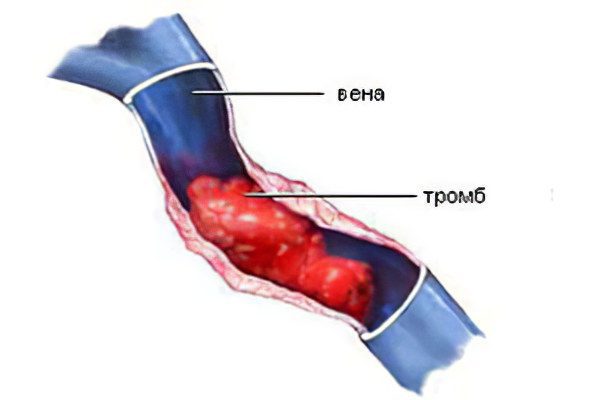 Iliac vein thrombosis