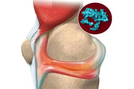 infectious arthritis