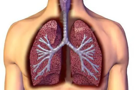 Infiltrative pulmonary tuberculosis