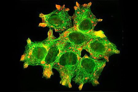 Infiltrative pulmonary tuberculosis