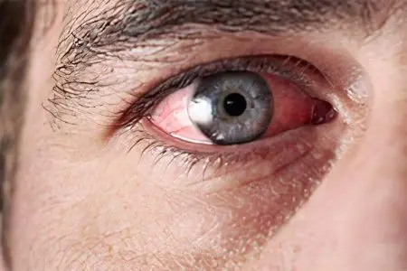 Inflammation of the eyes &#8211; how to wash and treat?