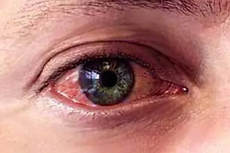 Inflammation of the eyes - how to wash and treat?