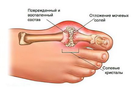 Inflammation of the joints - diseases, as a cause, symptoms and treatment