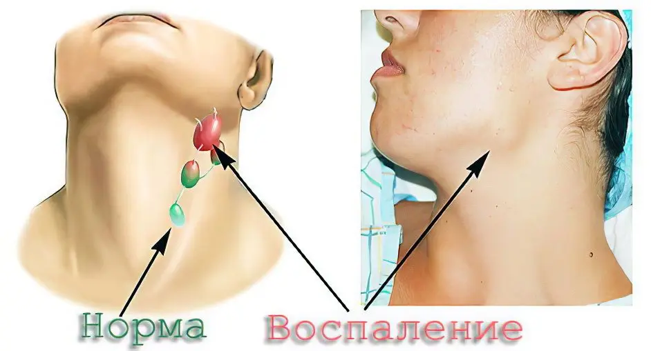 Inflammation of the lymph nodes in the neck: what are the causes?