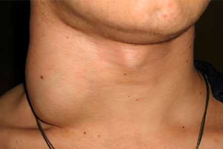 Inflammation of the lymph nodes in the neck: what are the causes?