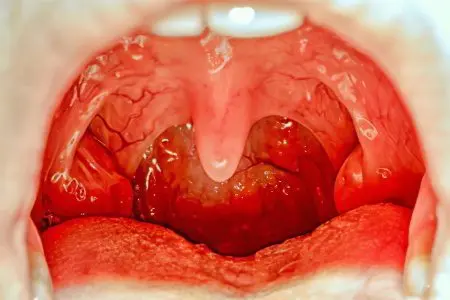 Inflammation of the tonsils: treatment methods