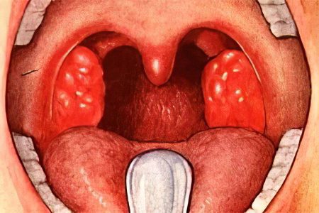 Inhalation for adenoids with a nebulizer