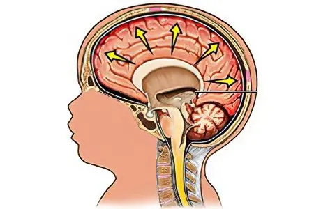 Internal hydrocephalus