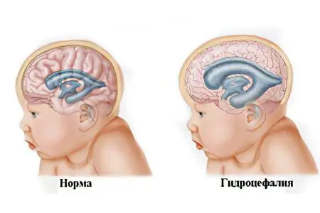 Internal hydrocephalus