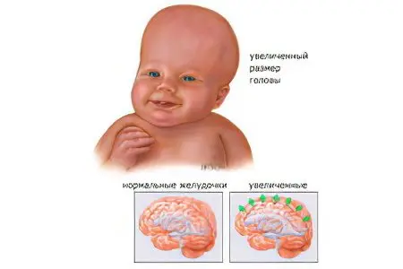 Internal hydrocephalus