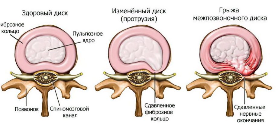 Intervertebral hernia: symptoms and treatment