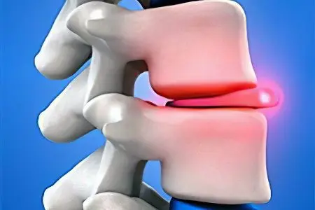 Intervertebral hernia: symptoms and treatment