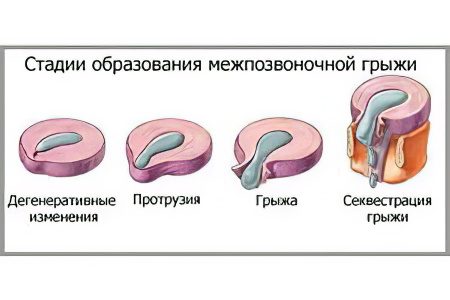 Intervertebral hernia: symptoms and treatment