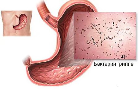 Intestinal (stomach) flu